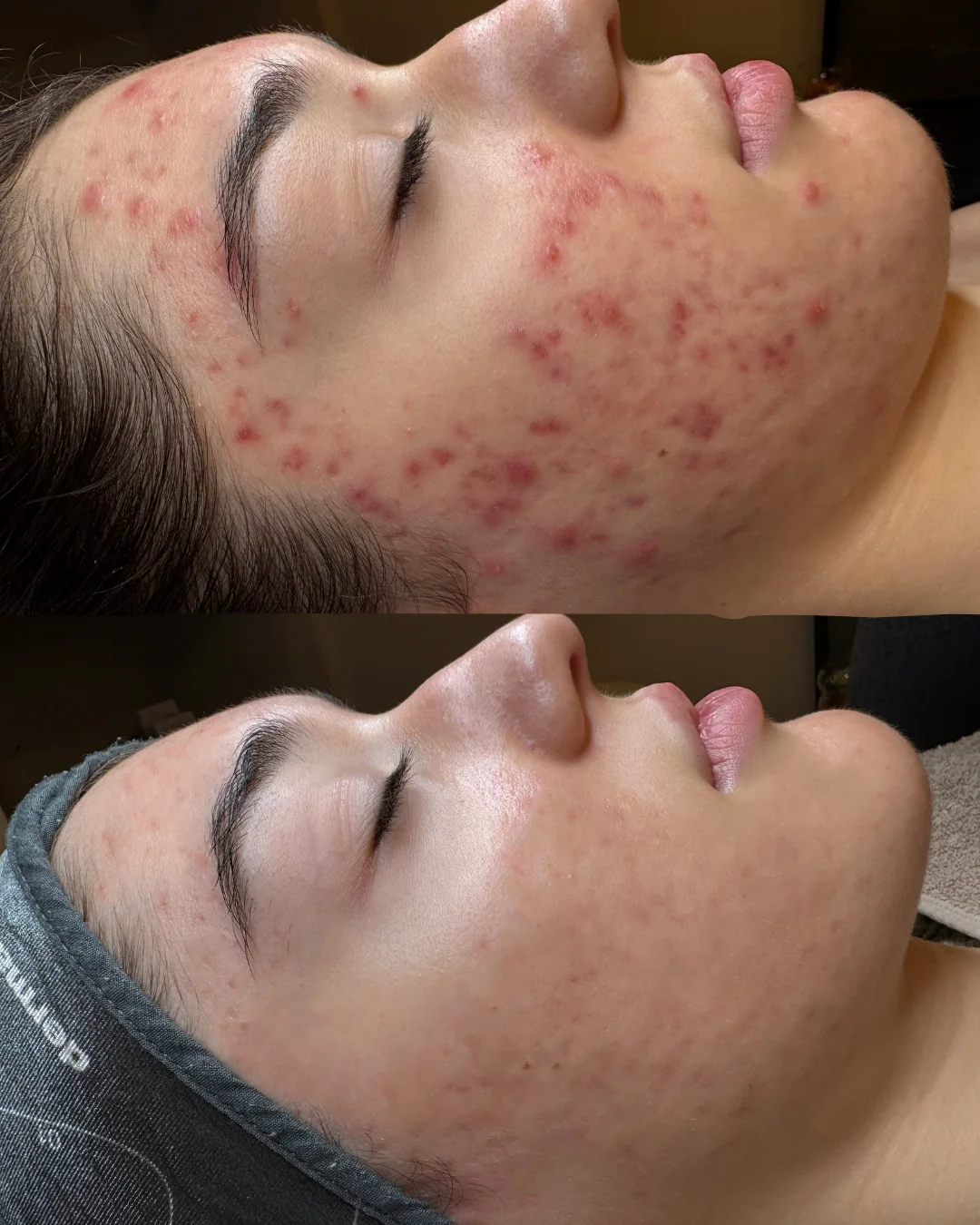 Fruchtsäurepeeling Vorher-Nachher bei NABEAU Freigegebener Vorher-Nachher-Vergleich einer Fruchtsäurebehandlung bei NABEAU in Berlin; Ergebnisse sind individuell