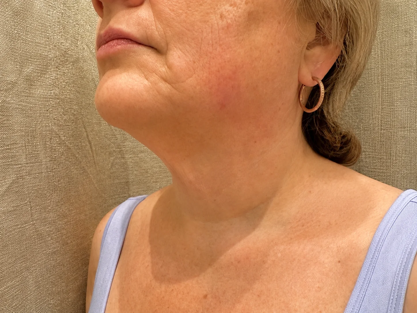 HIFU Nachher-Aufnahme – Hals und Kinnlinie Nachher-Aufnahme von Hals und Kinnlinie nach einer HIFU Behandlung bei NABEAU in Berlin