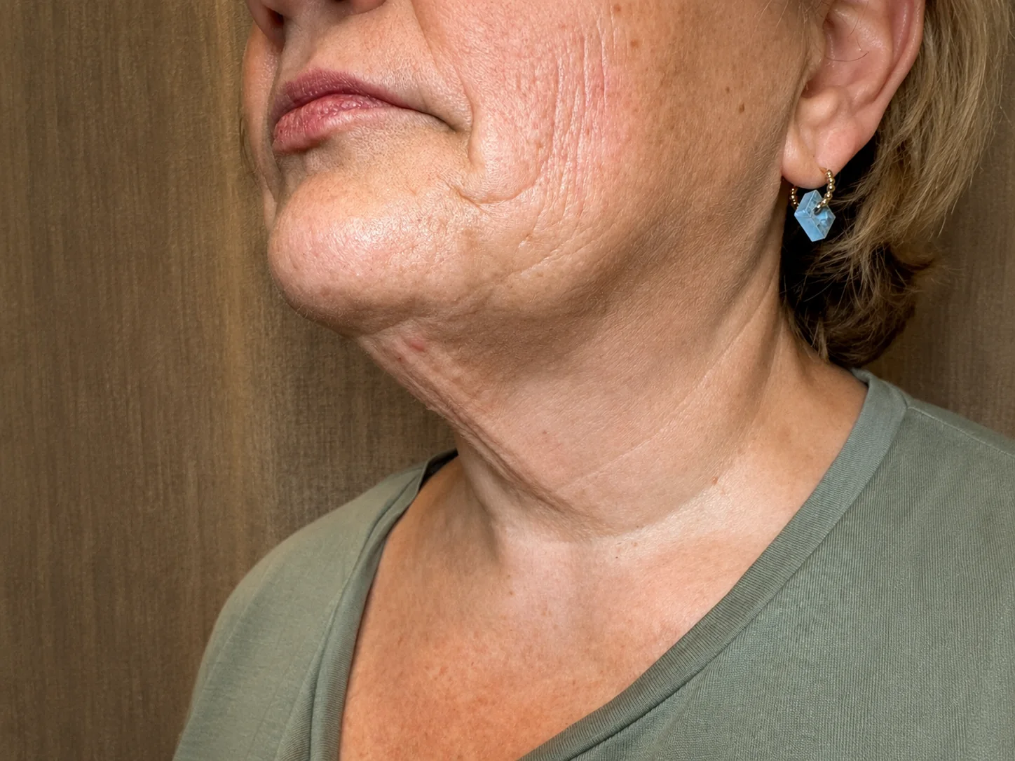 Vorher-Aufnahme von Hals und Kinnlinie vor einer HIFU Behandlung bei NABEAU in Berlin